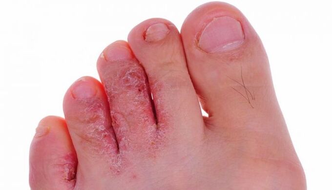 Fungal infection of the skin of the toes