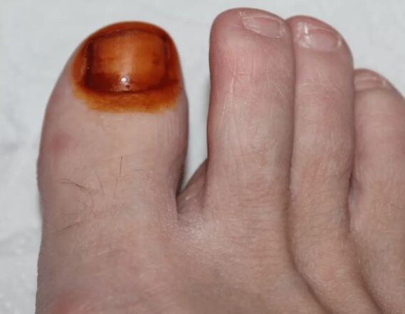 Treatment of mushroom yod