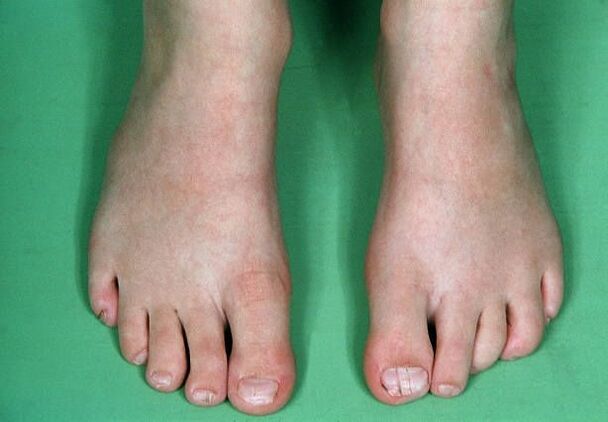 The fungus on the legs