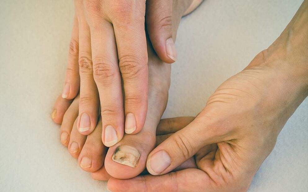 Toenail fungus how to treat
