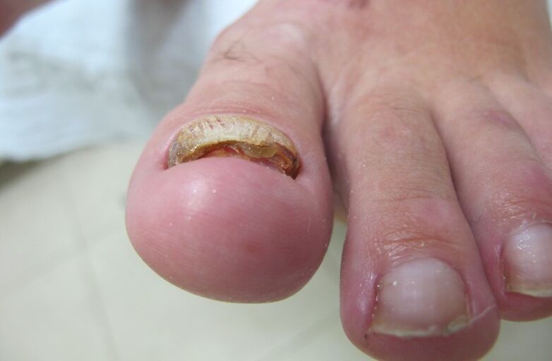 Exfoliation of the nail with a running fungus