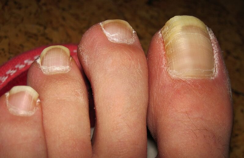 Yellowing of the toenails with fungus