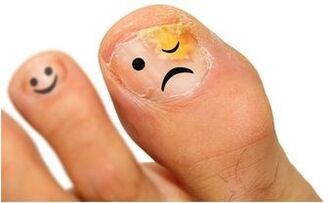 Yellow toenail fungus