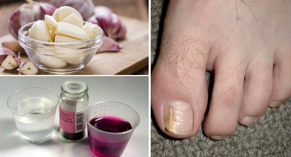 Garlic and potassium permanganate for toenail fungus