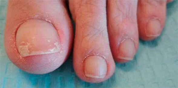 Phases of mushroom legs