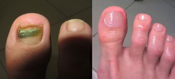 Treatment of nail fungus