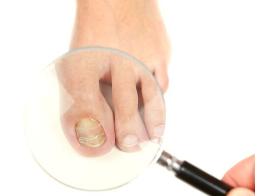 Toenail fungus