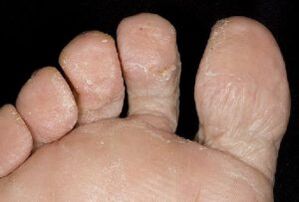 Symptoms of a fungus on the skin of the feet