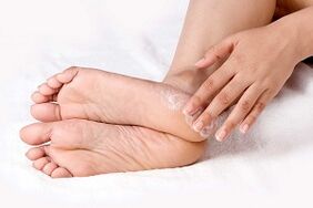 Treating athlete's foot with cream