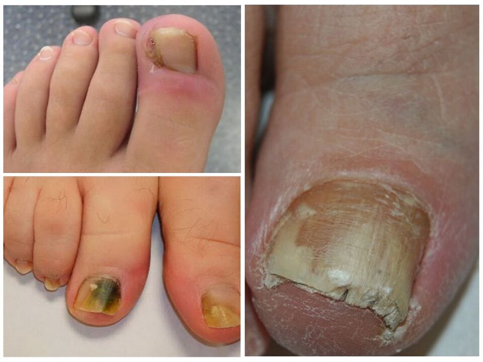 Fungal infection of the toenails