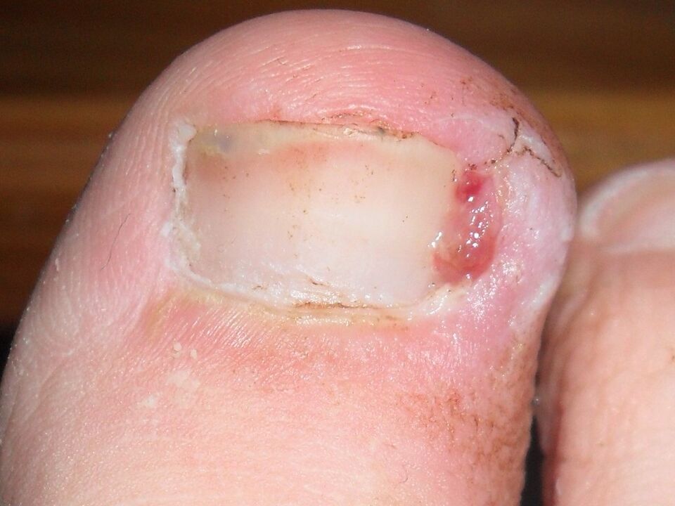 Ingrown toenail as a symptom of a fungal infection