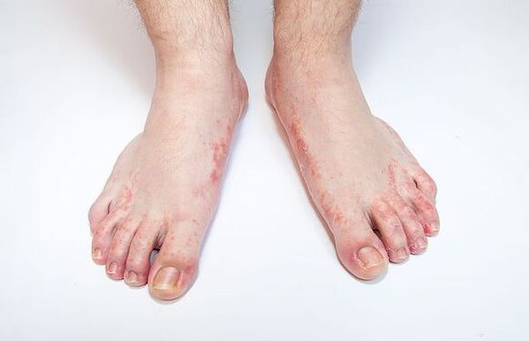 Fungal disease of the foot skin