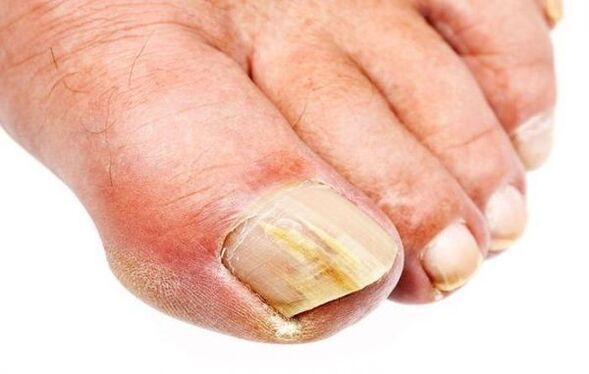 Onychomycosis – toenail fungus