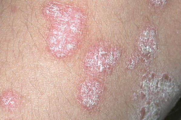Psoriasis caused by a fungal infection