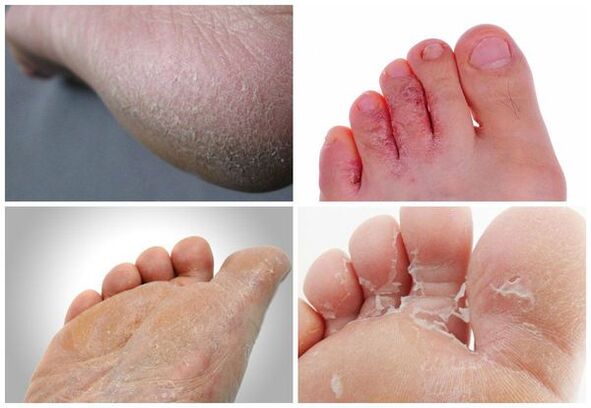 The main symptoms of mycosis of the feet are keratinization of the skin, cracks and peeling