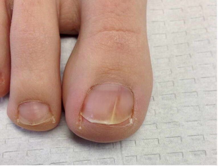 Fungal infection of the nail plate