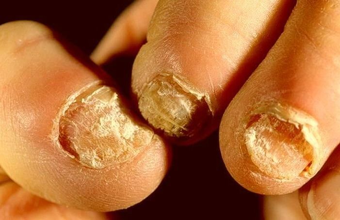Nail fungus how to treat