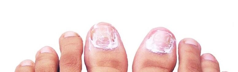 Nail ointment against fungus