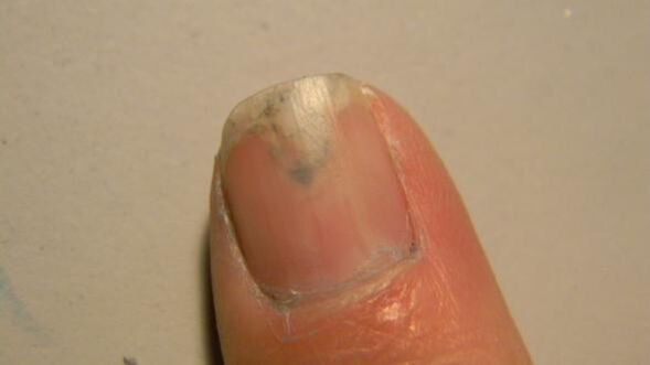 Symptoms of nail fungus
