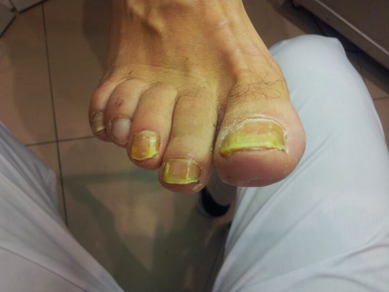 Yellow toenails due to fungus