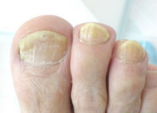 Advanced fungus on toenails