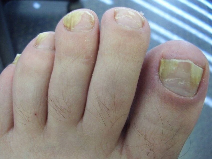 symptoms nail fungus